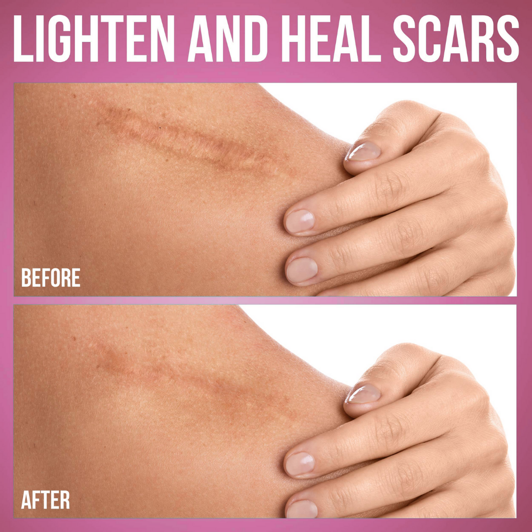 Smooth Patch™ Silicone Scar Sheets